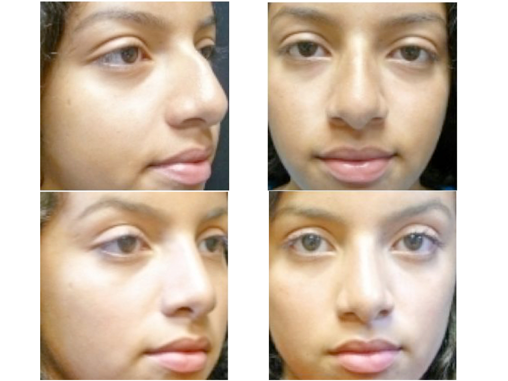 25 years old rhinoplasty