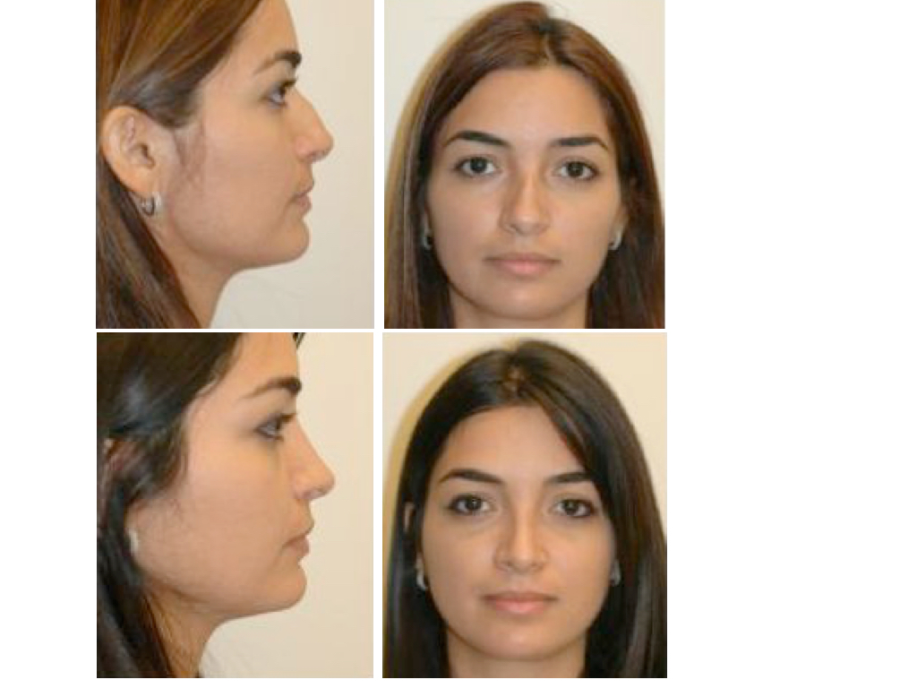 23 years old rhinoplasty
