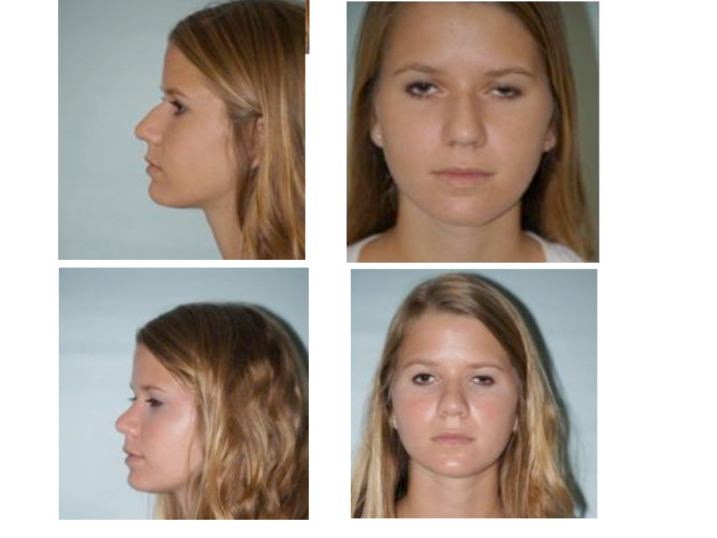 22 years old rhinoplasty