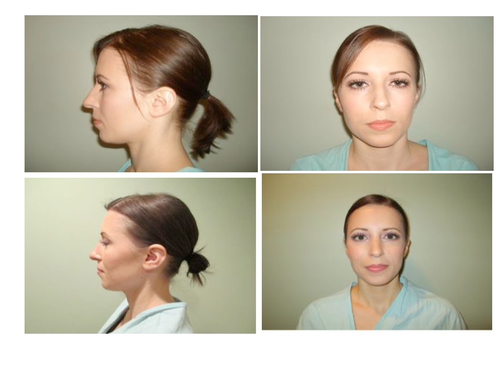 31 years old rhinoplasty