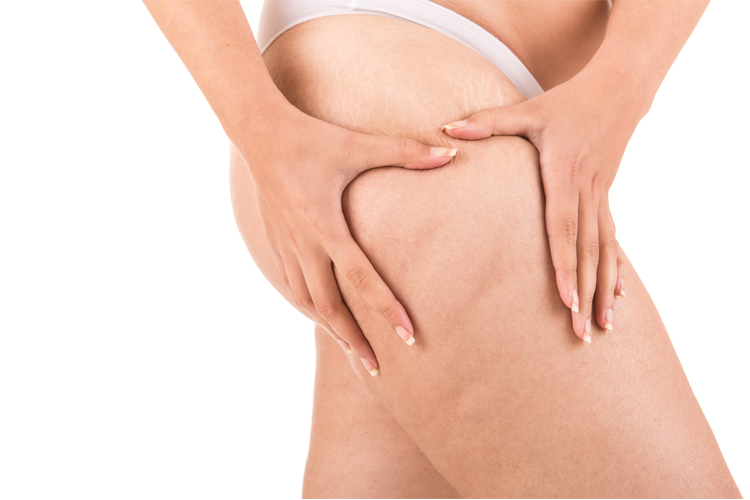 Liposuction