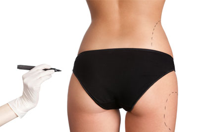 Liposuction