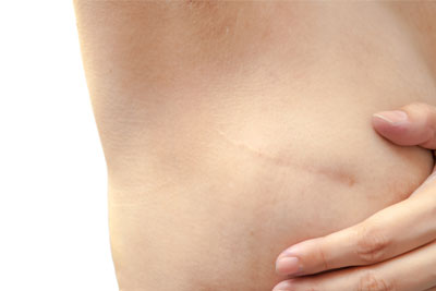 Breast Reconstruction