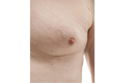 Gynecomastia