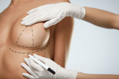 Breast Lift