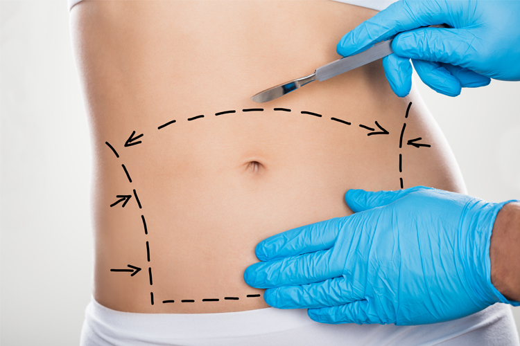 Abdominoplasty
