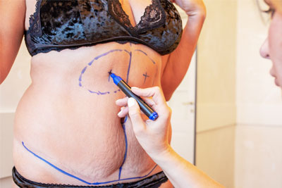 Abdominoplasty