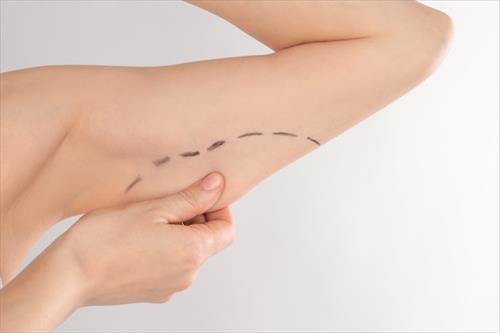 Brachioplasty-1