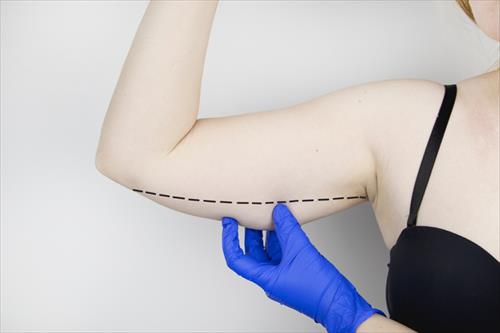 Brachioplasty-2