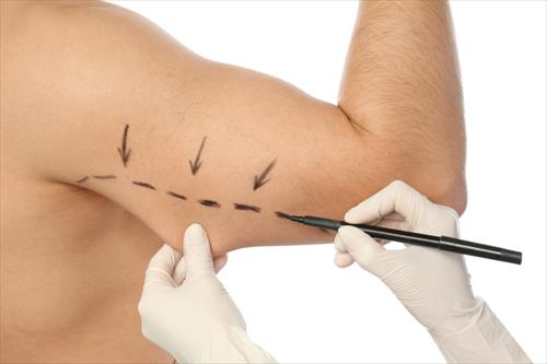 Brachioplasty-4